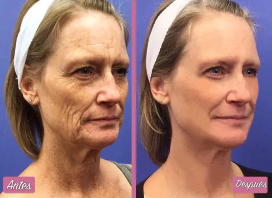 rejuvenecimiento-facial-laser-1